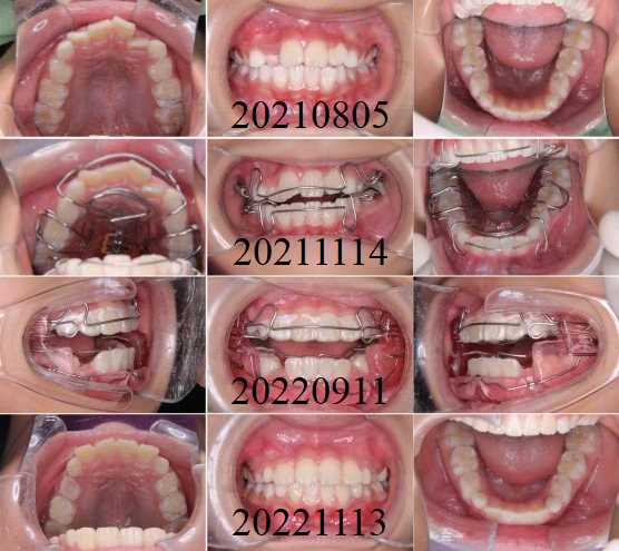 子どものアライナー治療例