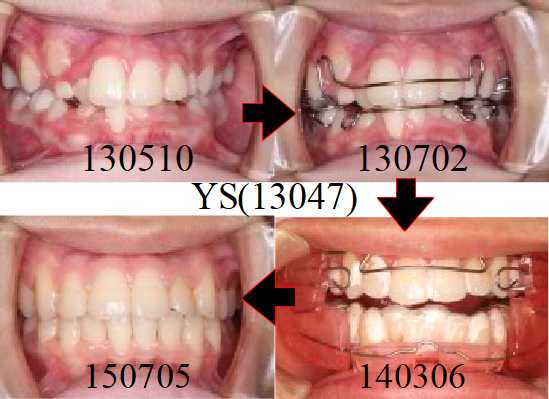子どものアライナー治療例