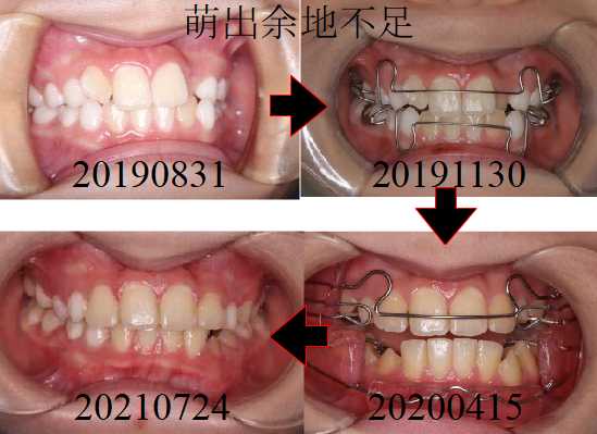 子どものアライナー治療例