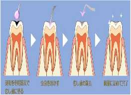 虫歯の治療