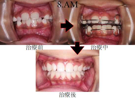 子どもの拡大治療例
