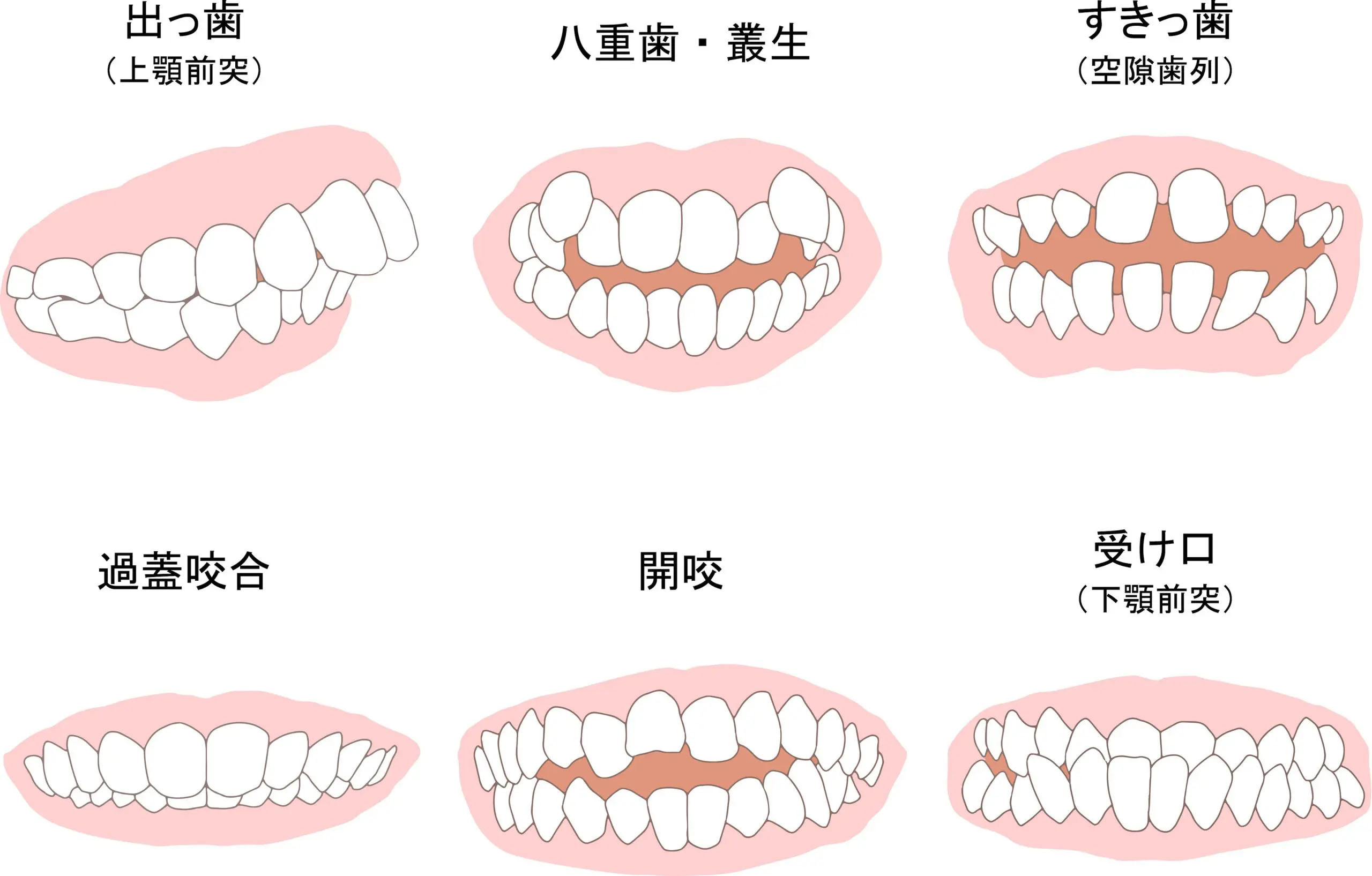 不正咬合