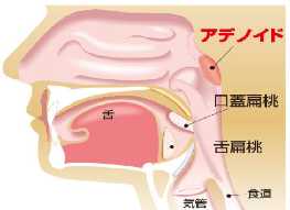 アデノイド