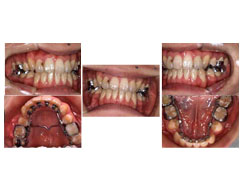 舌側矯正治療